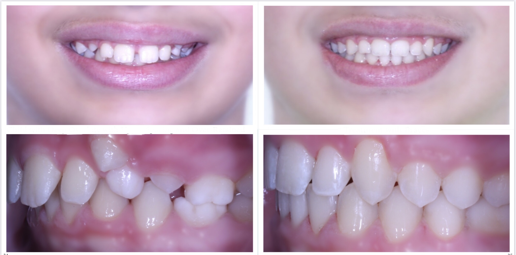 Before & After Orthodontic Treatment | Gallery